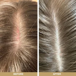 Australian Bodycare Hair Care Tee Tree Oil Scalp Serum Treatment Mask 150ml -Dermalogica Sale Store 12368622 1915058536553426